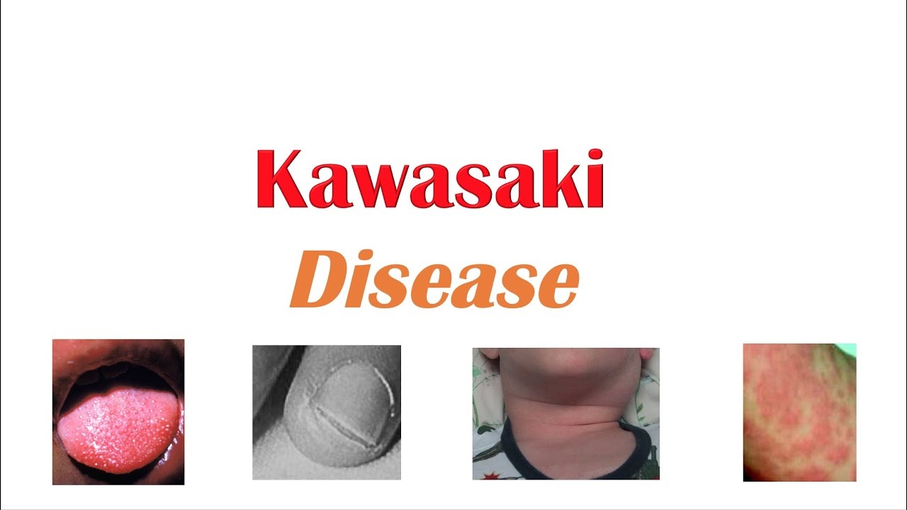 KAWASAKI DISEASE CLINICAL GUIDELINES