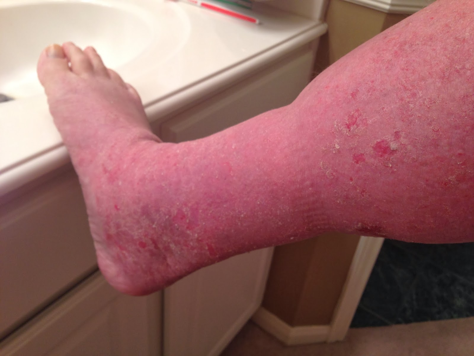 Dave's Topical Steroid Withdrawal January 31 MRSA