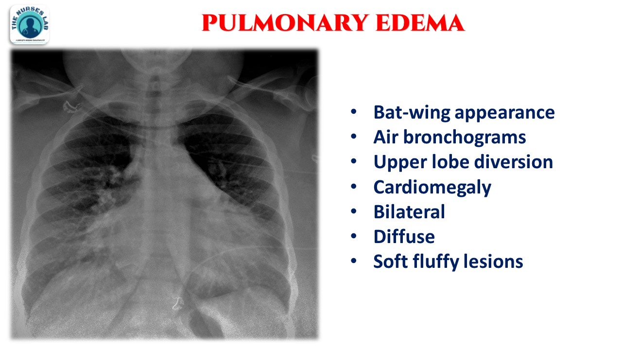 Abnormal Chest Xray Interpretation
