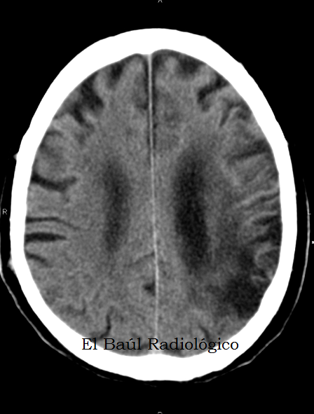 El Baúl Radiológico ENCEFALOMALACIA. HALLAZGOS EN TC e IRM