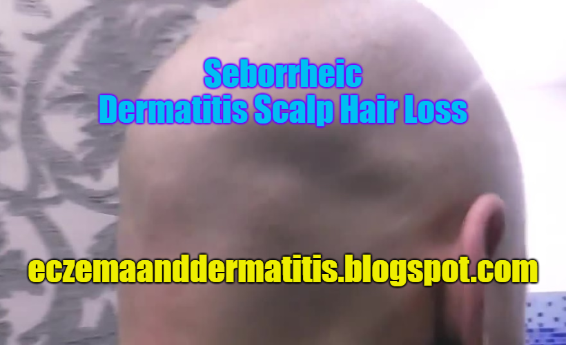 Seborrheic Dermatitis Scalp Hair Loss Eczema and Dermatitis