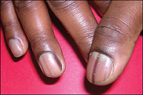 Causes of Dark Colored Nail Beds - wide 3