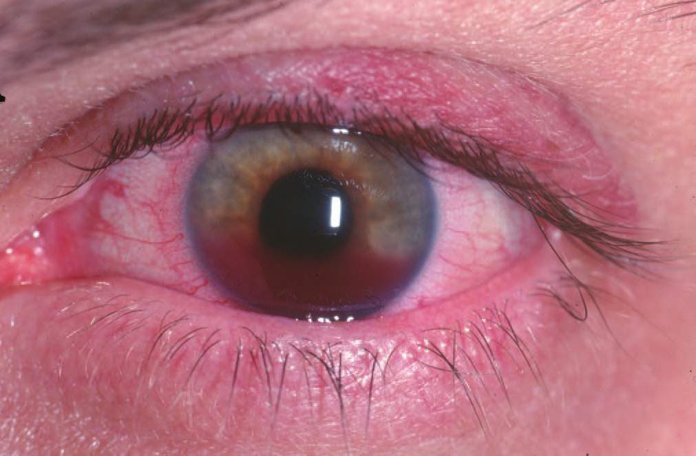 Study Medical Photos Hyphema a pooling or collection of blood inside the anterior chamber of