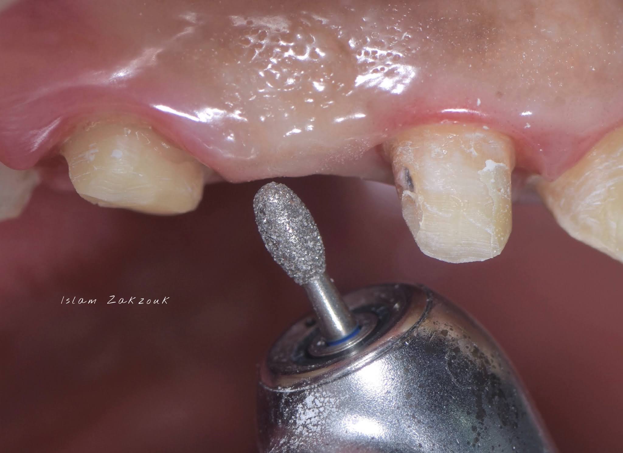 Ovate pontic for the correct emergence profile.. A clinical case Dental Esthetics