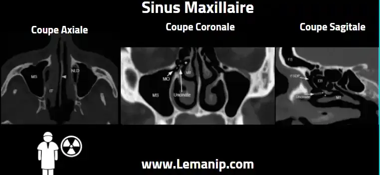 Anatomie Et Coupes Scanner Des Sinus Maxilaire