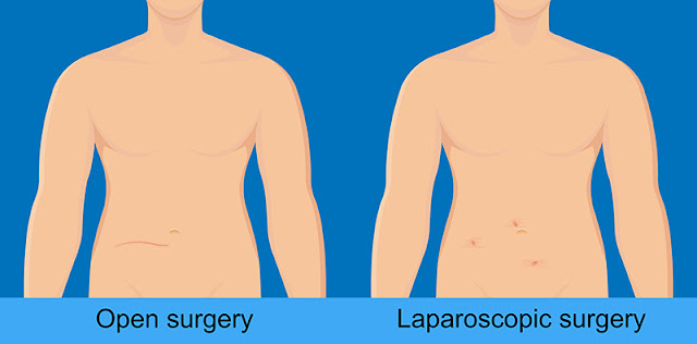 Different Types Of Hernia Chennai Gastro Care