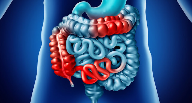 What is Crohn"s Disease? An Overview | El Paso, TX Chiropractor