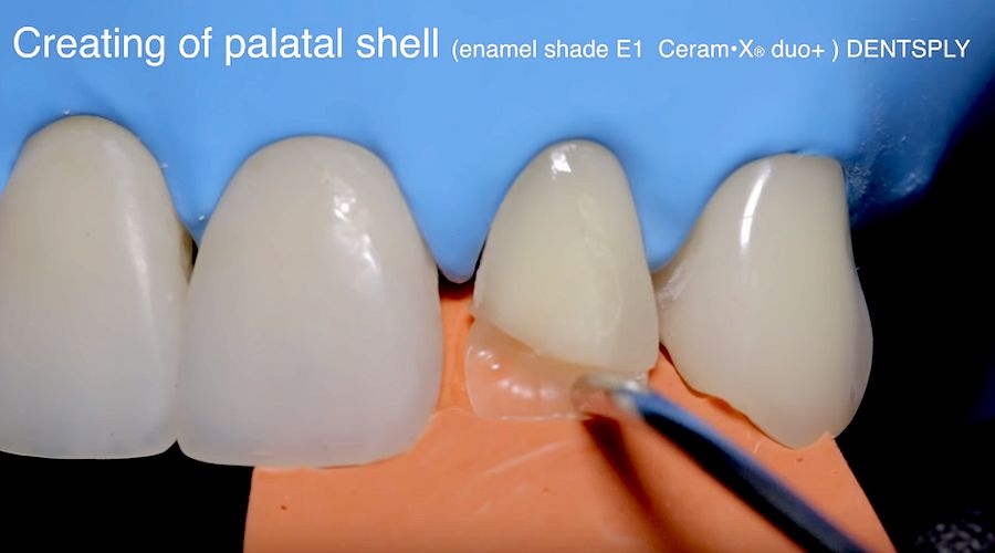 OPERATIVE DENTISTRY Direct restoration of frontal teeth Finishing