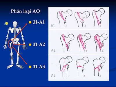 Phân độ gãy xương theo AO