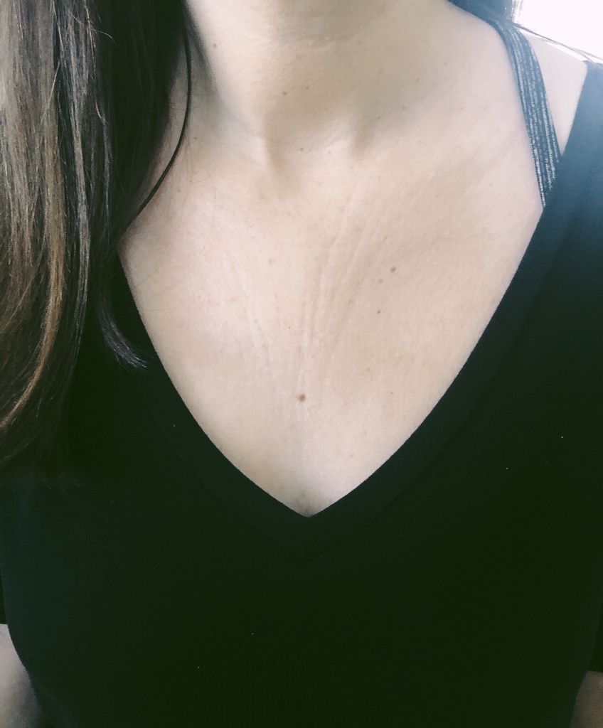 Treating Chest and Neck Wrinkles Beautygirl24 Treating Chest and