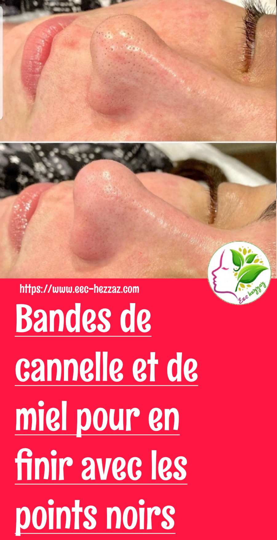 Bandes de cannelle et de miel pour en finir avec les points noirs