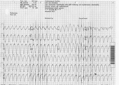 Clinical Electrocardiology ECG Blog