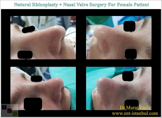 Natural rhinoplasty in Istanbul, nose job for female patient,Nasal valve collapse surgery, droopy nose tip aesthetic
