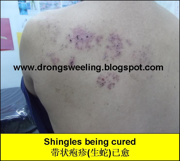 TCM News Best TCM Doctor for Shingles, Herpes Zoster, Postherpetic Neuralgia