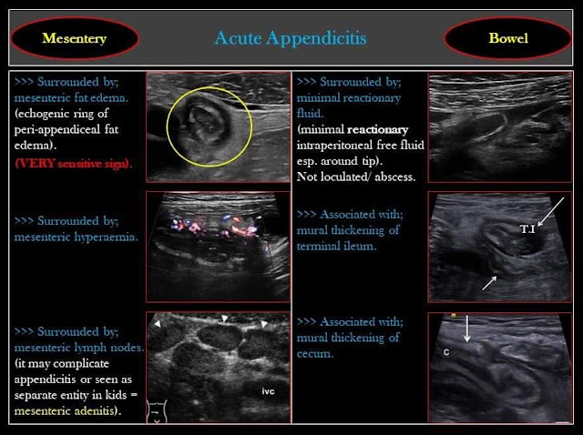 MEDICAL ULTRASOUND/ ACUTE APPENDICITIS