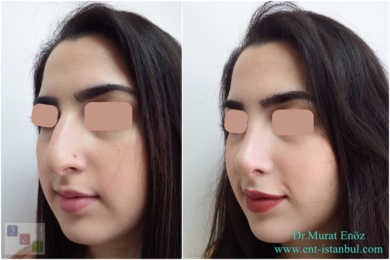 Health Zone Turkey Nose Job in Istanbul, Turkey