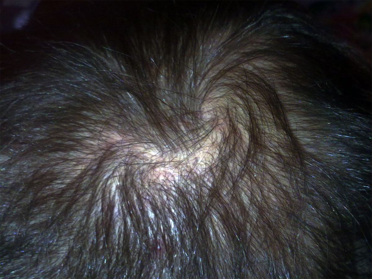 Dandruff Hair Loss Appropriate Steps to Curing It Hair Loss Treatment