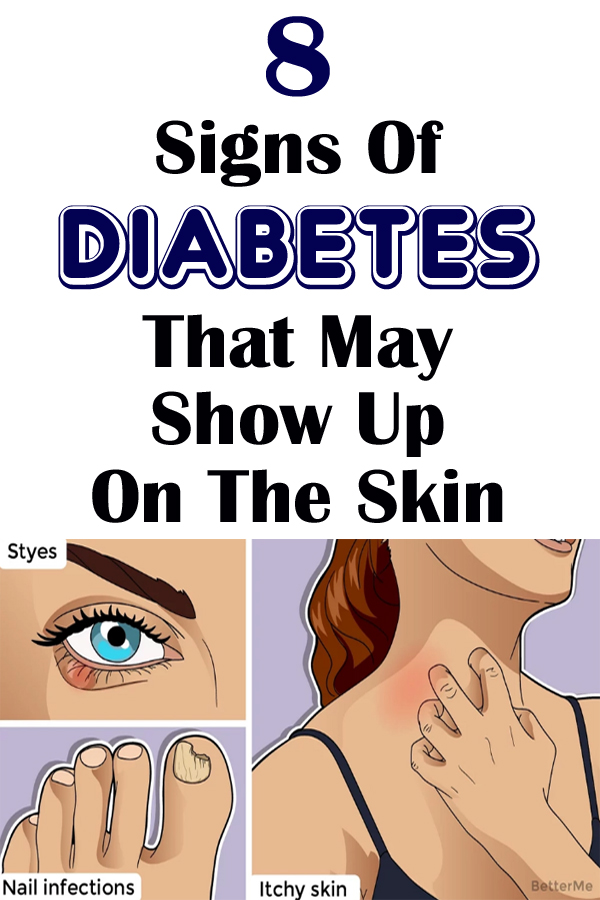 8 Signs Of Diabetes That May Show Up On The Skin