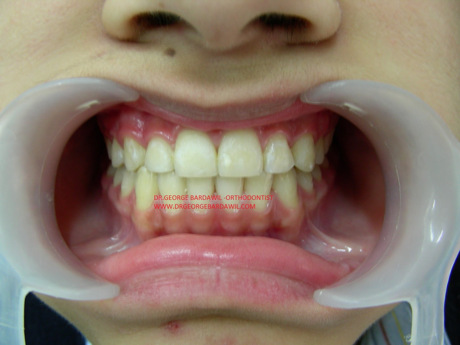 E. BardawilOrthodontistInvisalign Diamond level 1/1/12