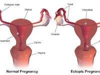 Tahukan anda kehamilan ektopik (hamil di luar kandungan)?