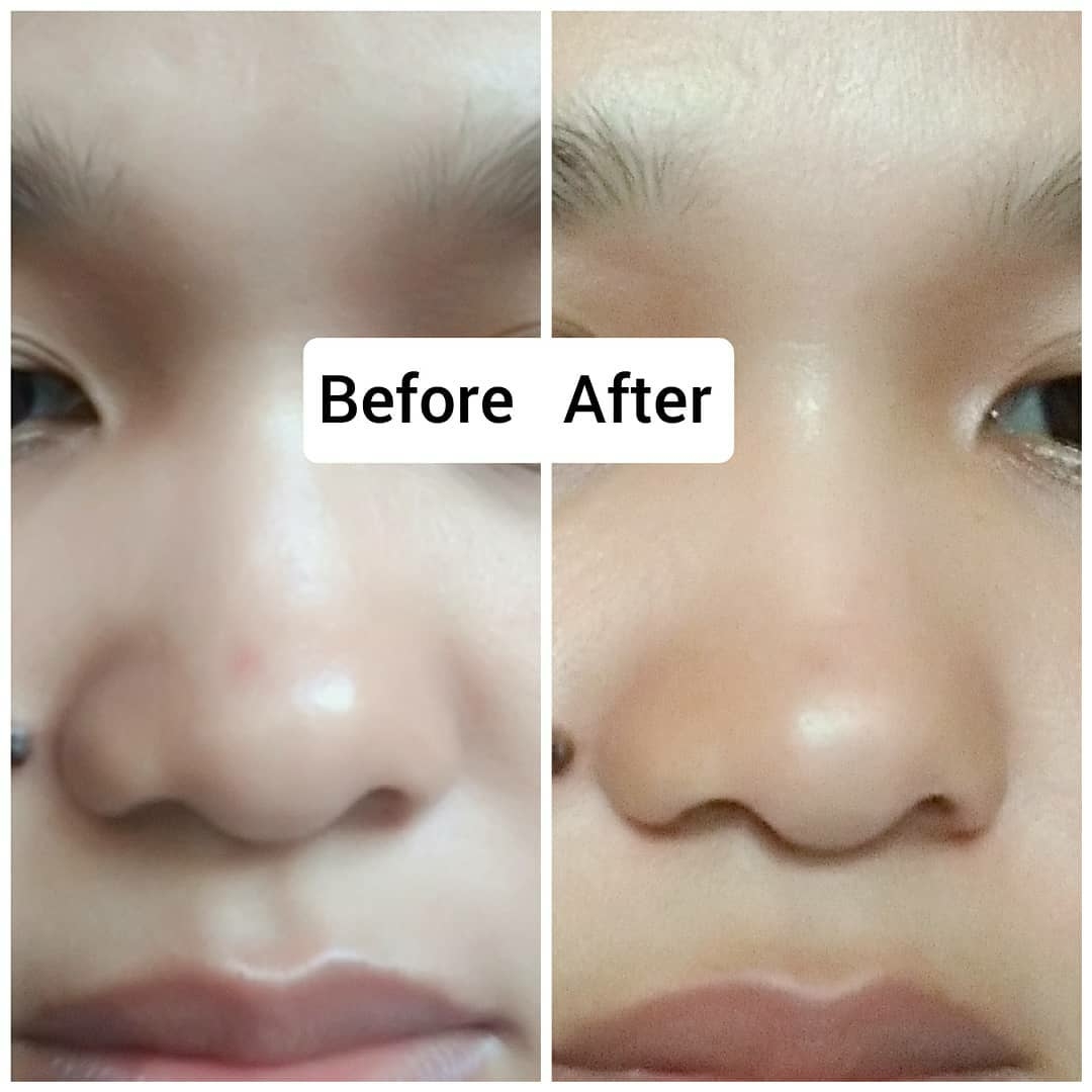 Madagascar Centella Ampoule Before And After at Neal Ching blog