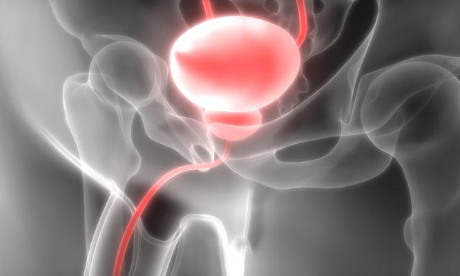 Καρκίνος του προστάτη: Τα πρώιμα συμπτώματα που πρέπει να γνωρίζει κάθε άντρας 