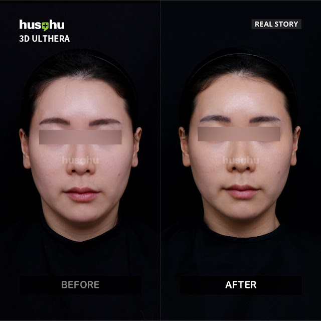 hushu-dermatology-ultherapy-real-story