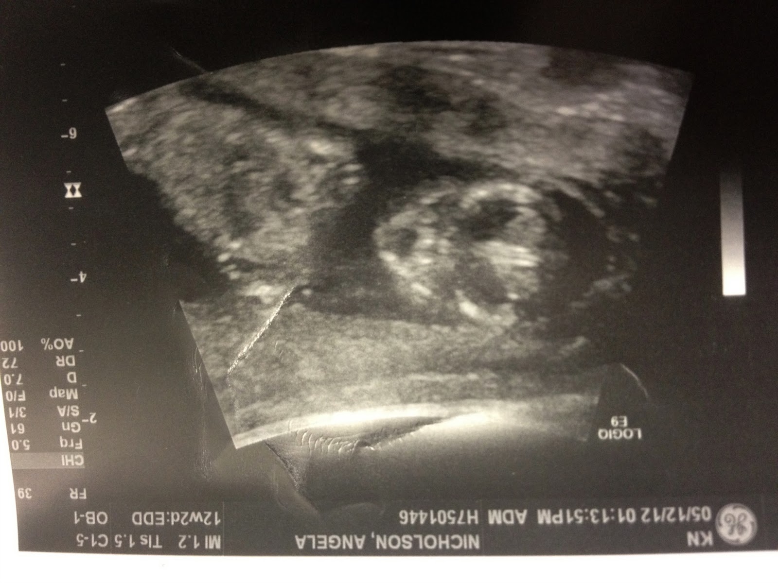 Our Journey Through Pregnancy: 12 Week Scan