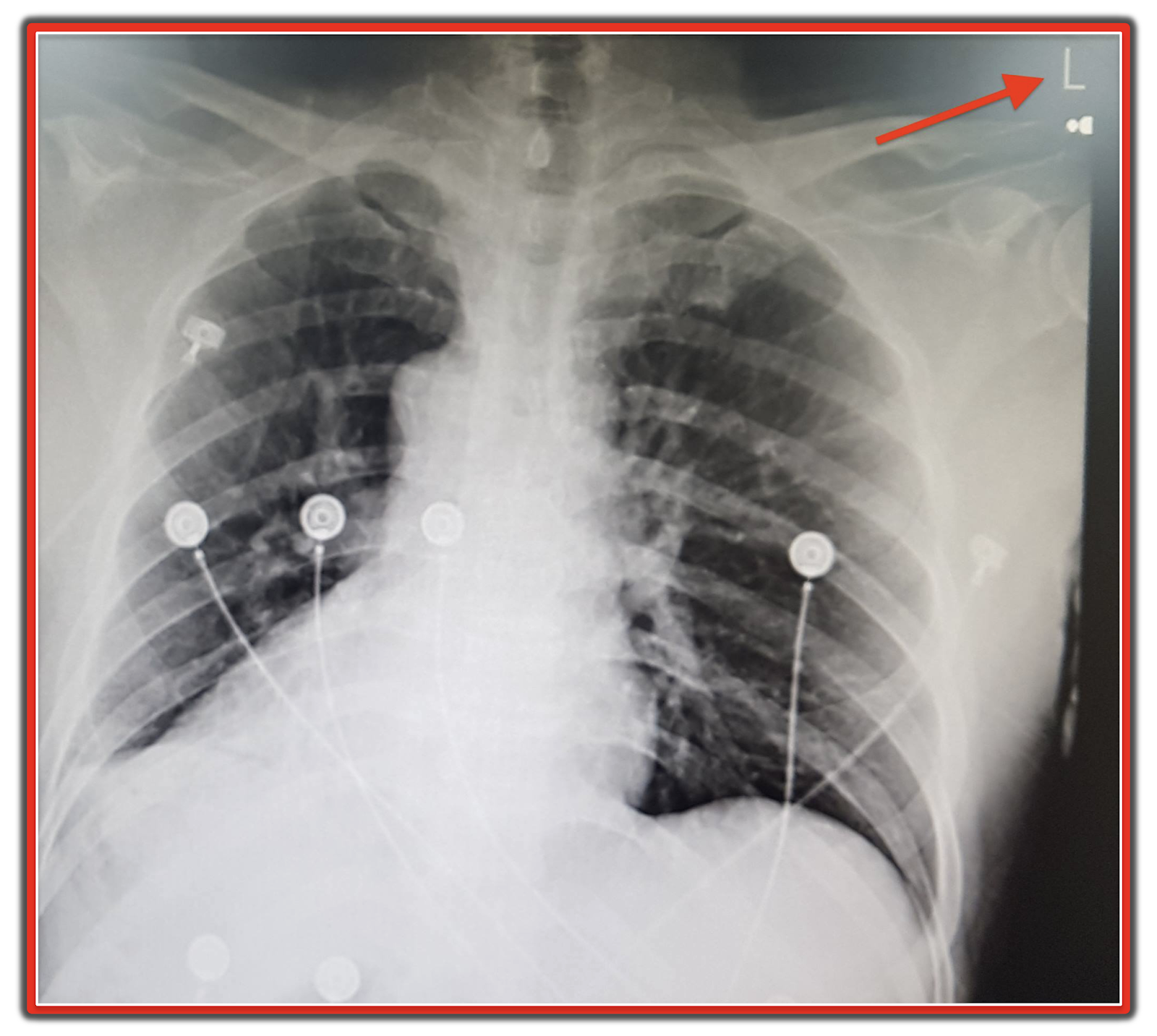 ECG Interpretation ECG Blog 175 (Lead Reversal Lateral MI