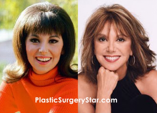 Marlo Thomas had facelift plastic surgery a few years back. 