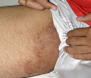 Ahlinya Obat Gatal Ahlinya Obat Gatal