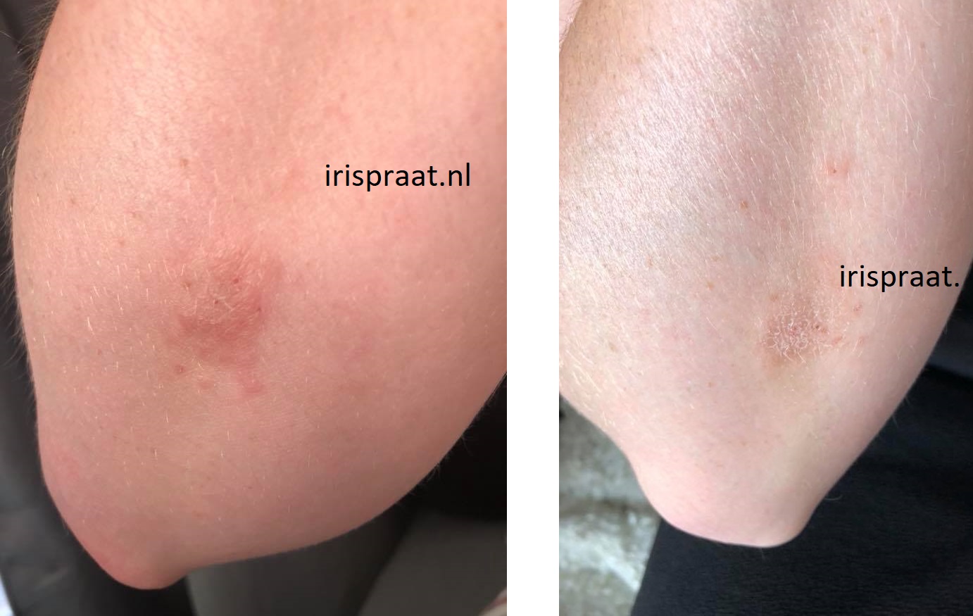 . Huiskamer dempen Review: Salcura Bioskin Dermaspray + Zeoderm - Irispraat.nl