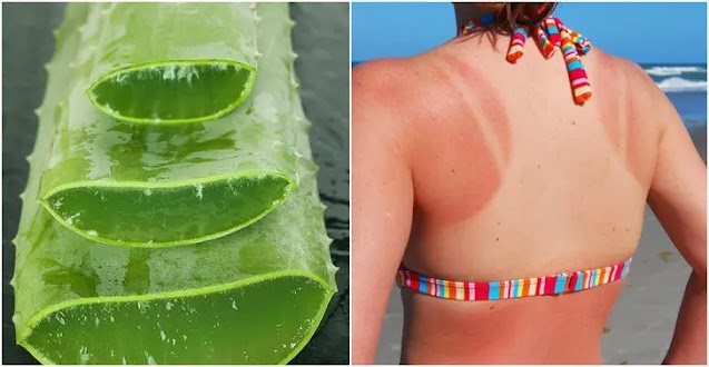 Aloe vera pour soigner les coups de soleil