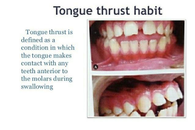 Habit Tongue Thrust Habit