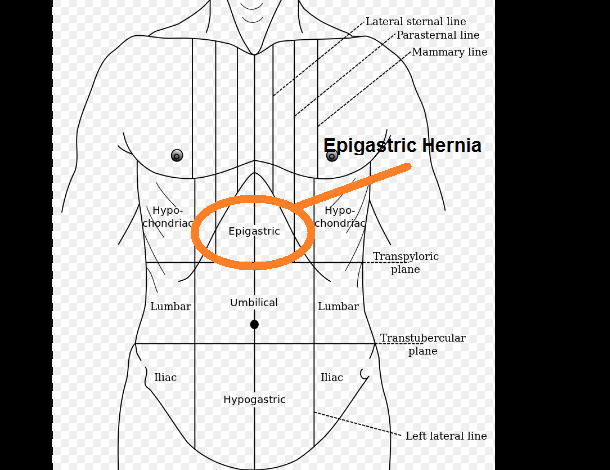 What Is Epigastric Hernia Swami Dayanand Naturopathy Hospital
