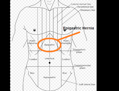 What is Epigastric Hernia - Swami Dayanand Naturopathy Hospital