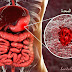 قرحة المعدة _اعراض واسباب وتشخيص قرحة المعدة stomach ulcer قرحة المعدة _اعراض واسباب وتشخيص قرحة المعدة stomach ulcer