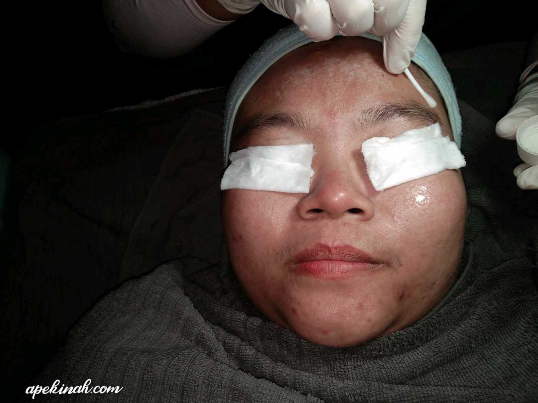 Buat Rawatan OxyPeel C Untuk Merawat Parut Di Dr Medispa & Wellness Buat Rawatan OxyPeel C Untuk Merawat Parut Di Dr Medispa & Wellness