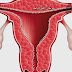 سرطان عنق الرحم -اعراض سرطان عنق الرحم Cervical cancer سرطان عنق الرحم -اعراض سرطان عنق الرحم Cervical cancer