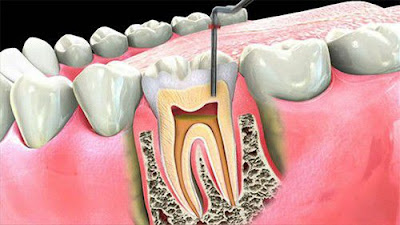 Dấu hiệu nhận biết tủy răng chết và cách điều trị-1