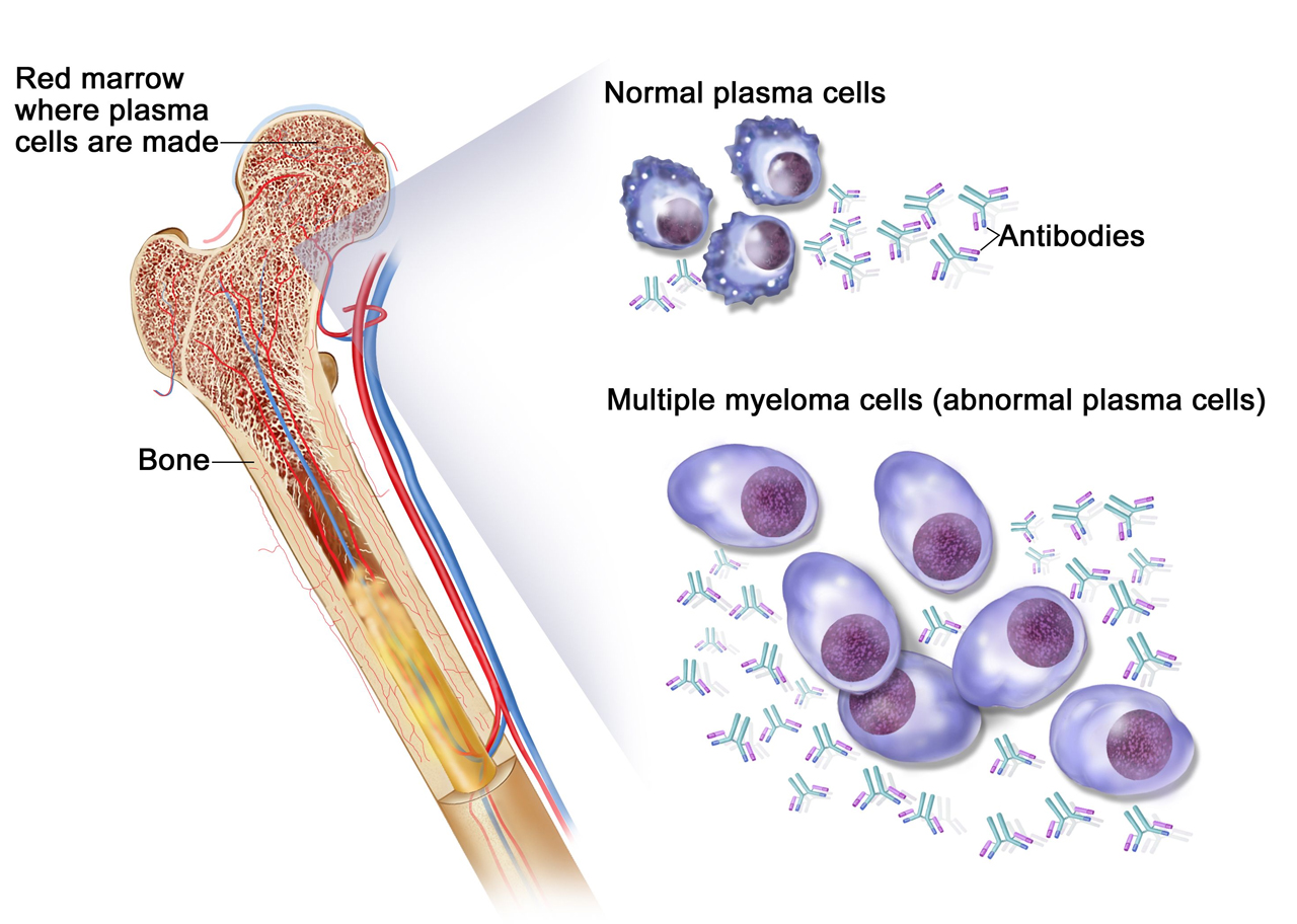 Medical Terms & Сlinical Сases Kahler’s disease