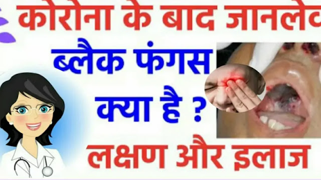 Black fungus या mucromycosis symptoms in Hindi