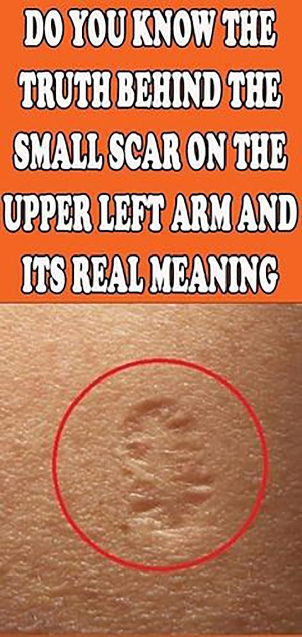 Do You Know the Truth Behind The Small Scar On The Upper Left Arm and