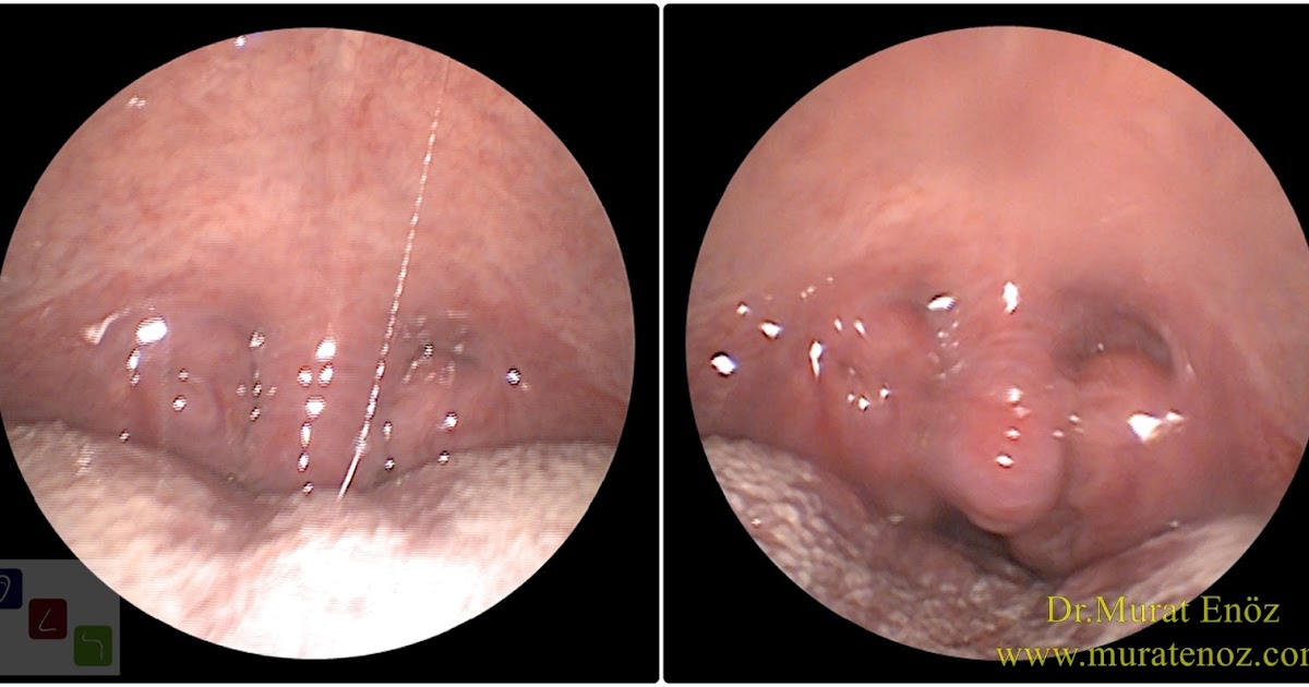 İri Bademcikler Sebebi Olabiliyor! İri Bademcikler Sebebi Olabiliyor!