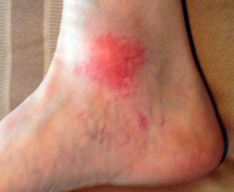 What is red rash around lower leg above the ankle? - MedHelp