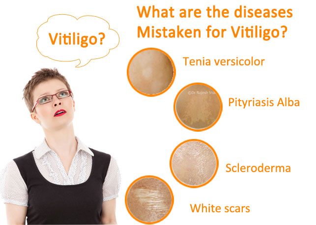 How Vitiligo Affects An Individual Life Symptoms And Causes Of Leucoderma