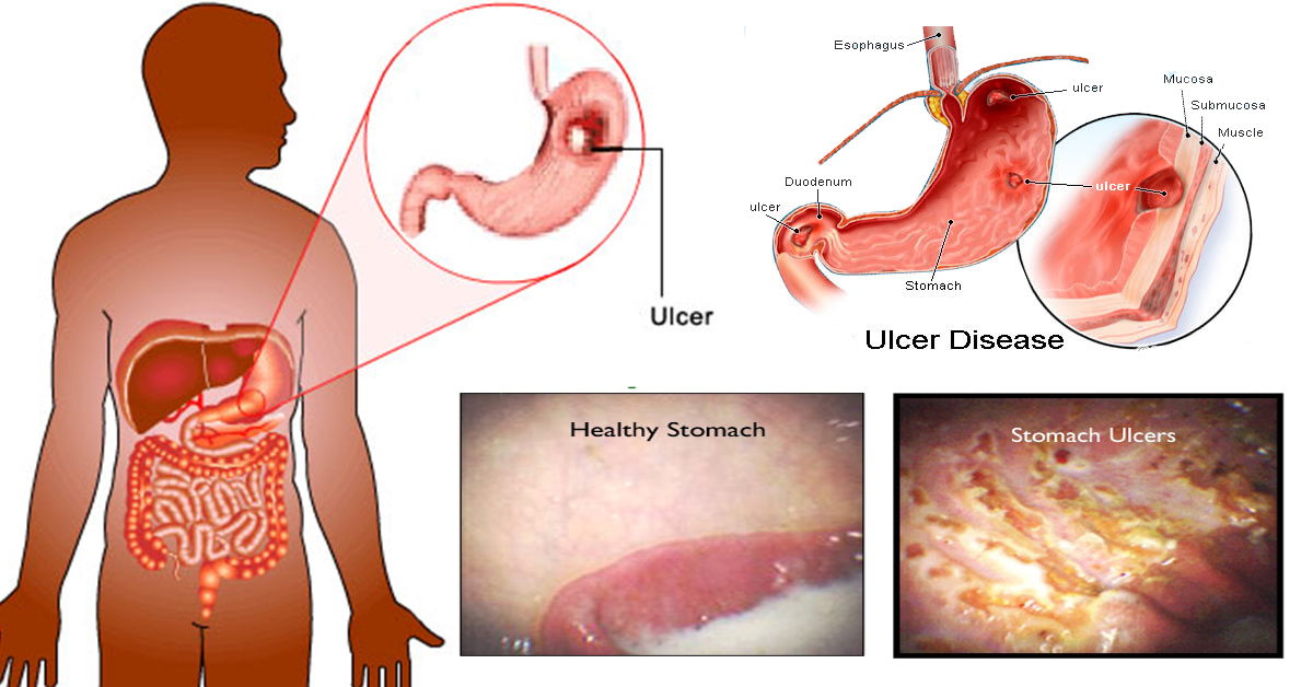 Stomach Ulcer Treat Naturally Stomach Ulcer Treat Naturally