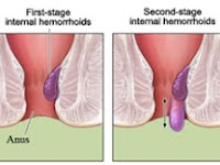 Lamanya Penyakit Wasir Atau Ambeien