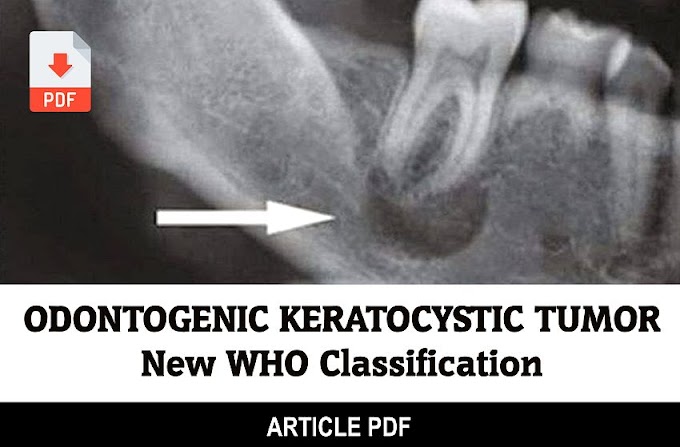 PDF: Odontogenic Keratocystic Tumor: A Clinical and Histopathologic Retrospective Study Based on the New WHO Classification