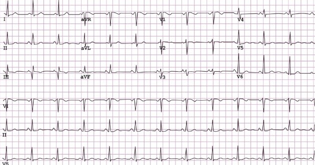 ECG TEST - WHEN IT IS DONE AND HOW IT IS DONE